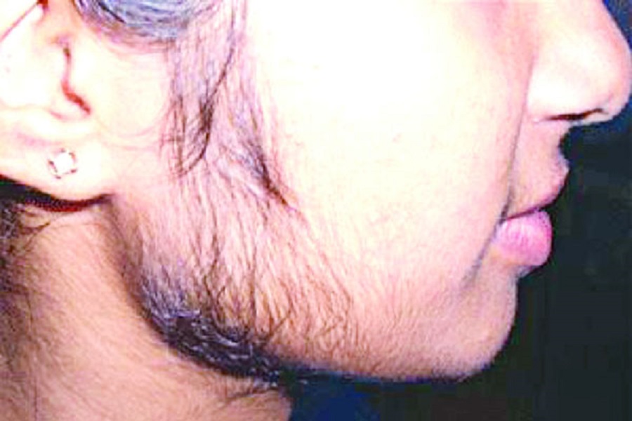 Wondering the normal occurrence of teenage facial hair growth? You know there are many terrible reasons behind this!