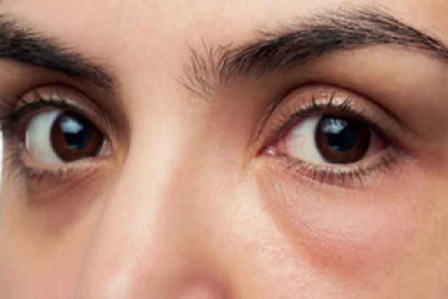 Feeling uncomfortable under the eyes? Solve the problem in just 2 days with home remedies