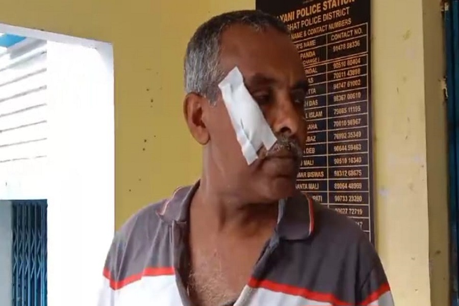 Deputy Magistrate's face cracked by security guards at Kalyani's Gandhi Hospital